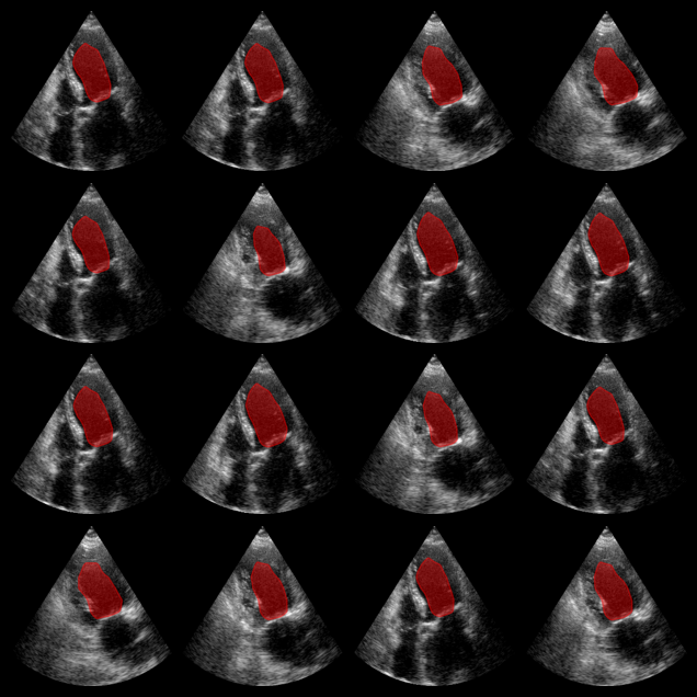 EchoNet-Dynamic Example Output